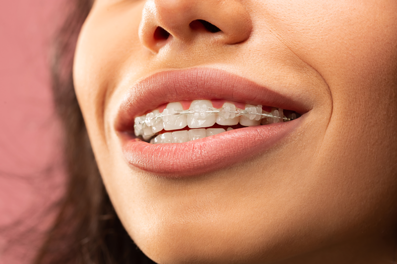Nahaufnahme eines lächelnden Mundes mit Keramikbrackets