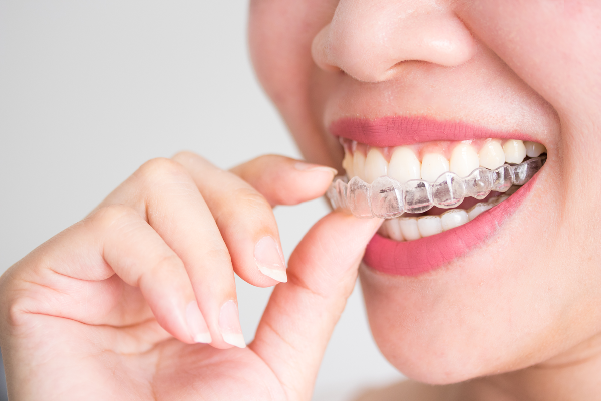 Aligner-Therapie als Bestandteil der ästhetischen Kieferorthopädie 