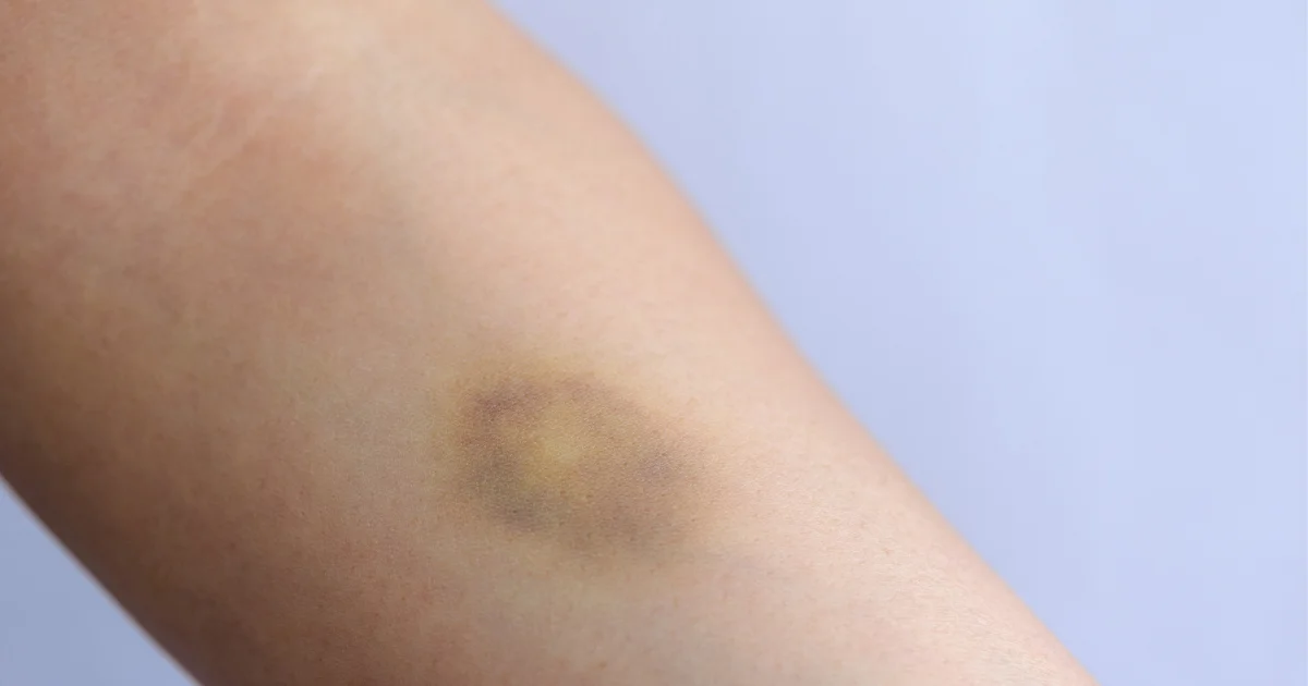 women's arm with a bruise made by a mounjaro injection