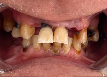 Close-up of teeth with severe discoloration and decay.