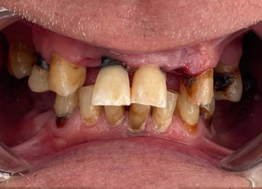 Close-up of teeth with severe discoloration and decay.