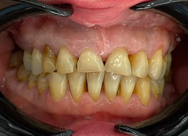 Close-up of teeth with severe plaque buildup and discoloration, showing yellow and brown staining.