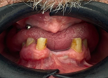 Close-up of discolored upper and lower teeth with yellow plaque buildup and inflamed gums.