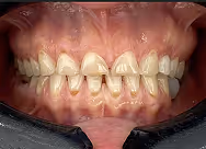 Close-up of upper and lower teeth showing worn and chipped front teeth with visible gum tissue.