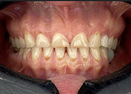 Close-up of upper and lower teeth showing worn and chipped front teeth with visible gum tissue.