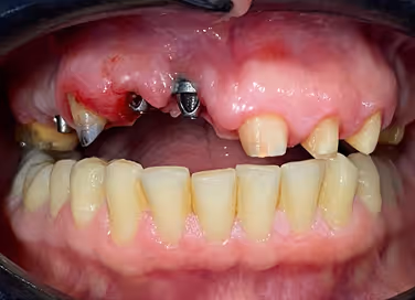 Close-up of teeth with heavy yellow plaque and tartar buildup on upper and lower front teeth and gums.