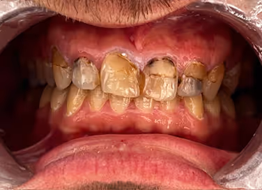 Close-up of a mouth with missing upper front teeth, gaps between lower teeth, and slightly stained teeth.