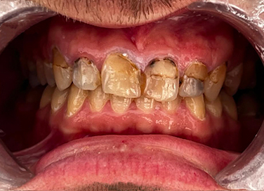 Close-up of a mouth with missing upper front teeth, gaps between lower teeth, and slightly stained teeth.