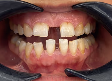 Close-up of upper and lower teeth showing discoloration, plaque buildup, and gum inflammation.