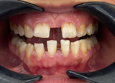 Close-up of upper and lower teeth showing discoloration, plaque buildup, and gum inflammation.