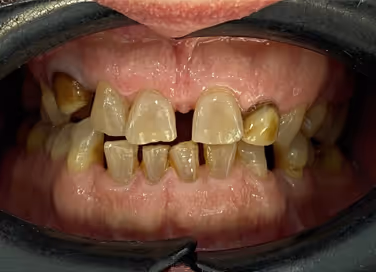 Close-up of upper and lower teeth showing missing upper right canine, tooth decay, and plaque buildup.