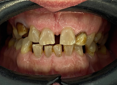 Close-up of upper and lower teeth showing missing upper right canine, tooth decay, and plaque buildup.