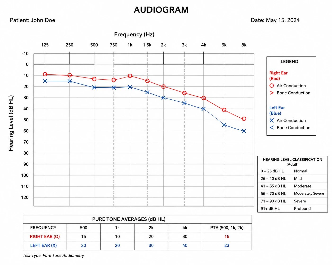 Audiogram chart showing hearing thresholds for the left and right ears across frequencies from 125 Hz to 8 kHz, illustrating how to read hearing test results.