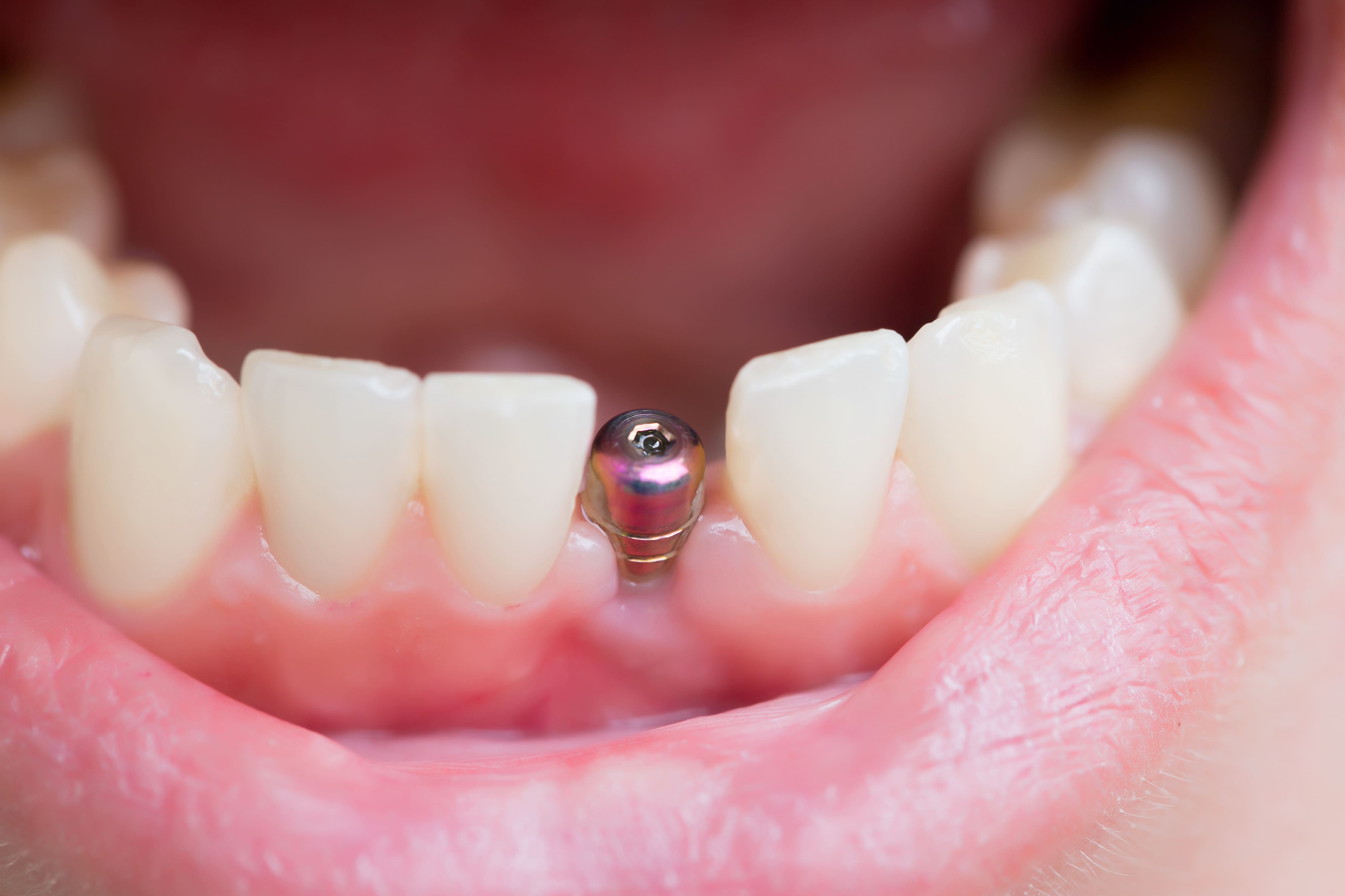 What to Expect After Dental Implant Surgery: Recovery Tips for Faster Healing