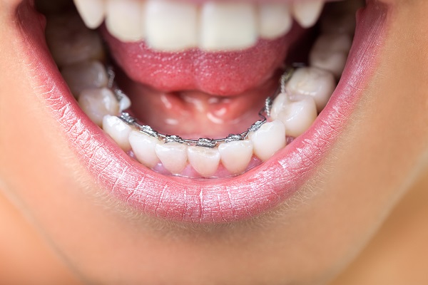 Close-up of lingual braces placed behind the teeth for a discreet orthodontic treatment option