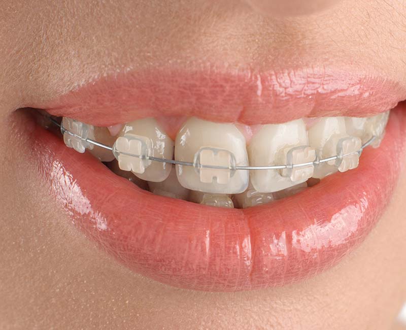 Close-up of clear ceramic braces on teeth for a more discreet orthodontic treatment option