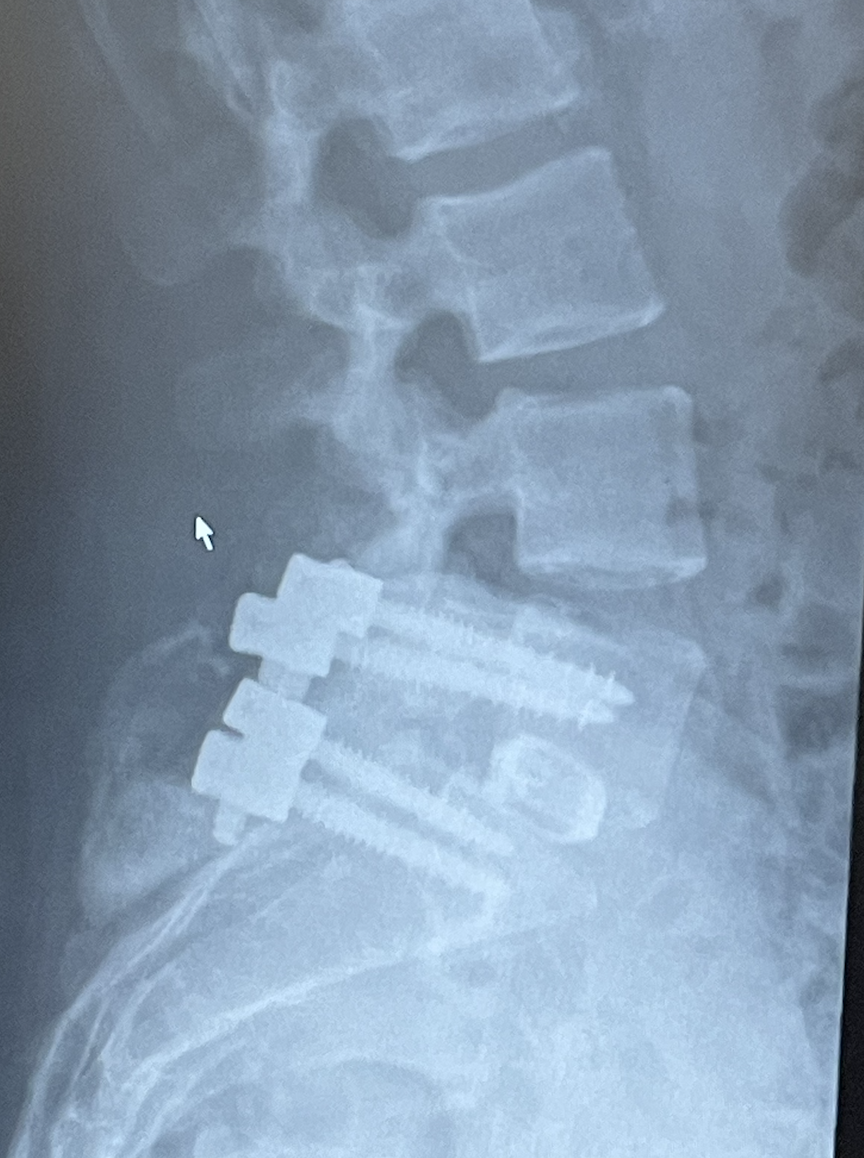 X-ray showing spinal fusion hardware following back surgery