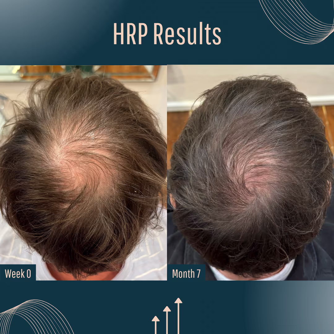 HRP Before and after images (more hair coverage on after)