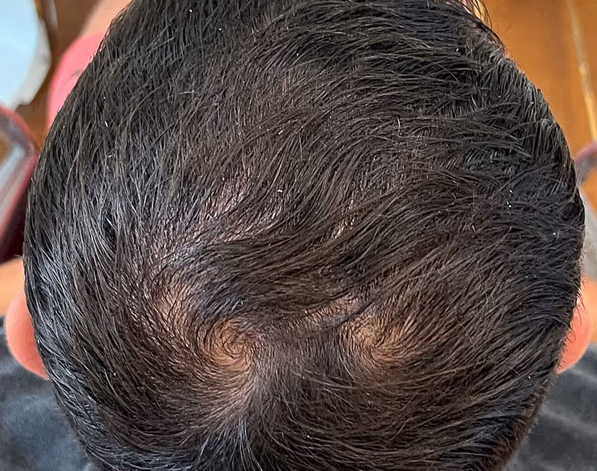 Proven, Non-Invasive Hair Restoration.