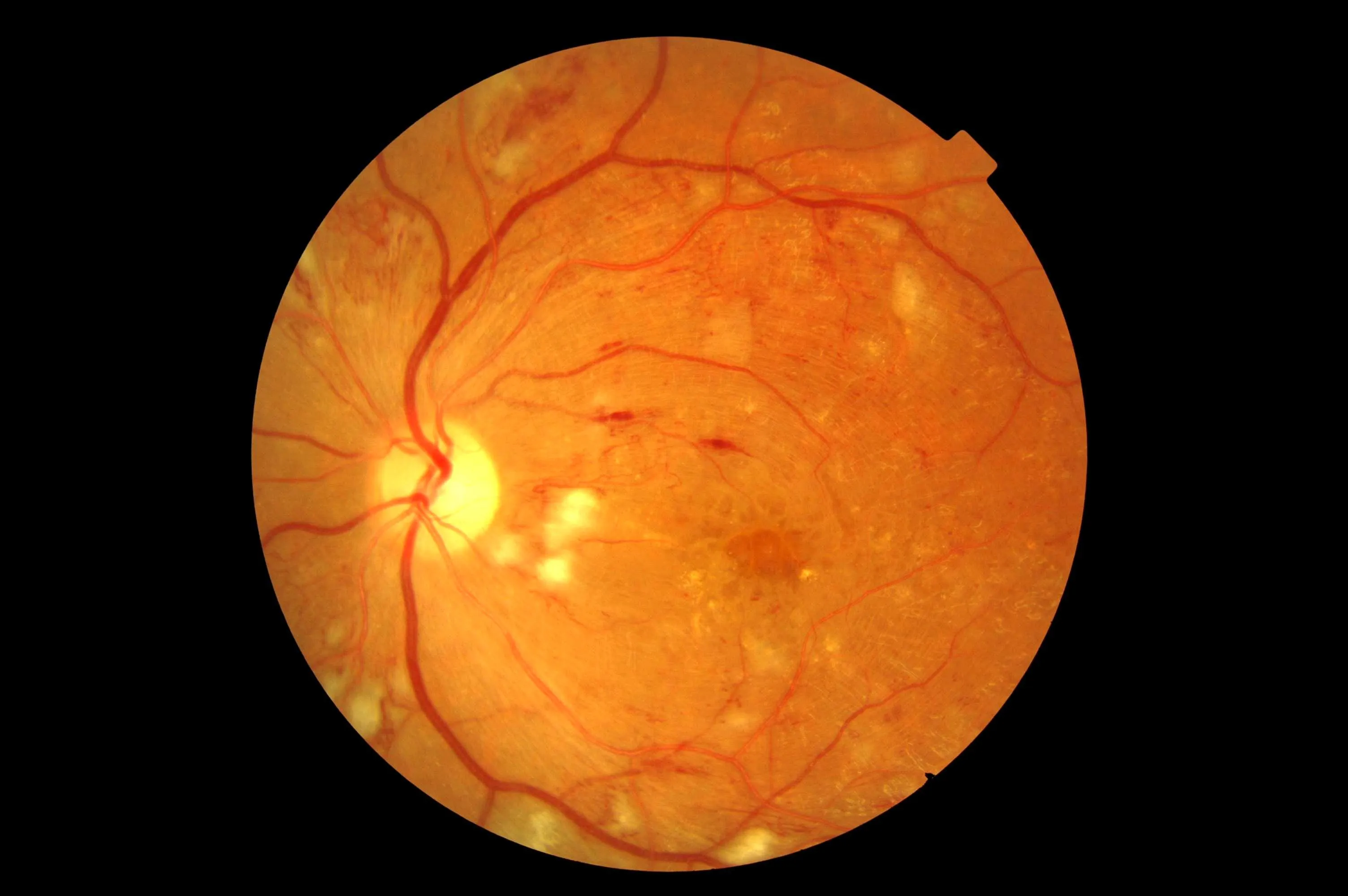 Close-up image of a human retina showing blood vessels and optic disc with signs of retinal abnormalities.