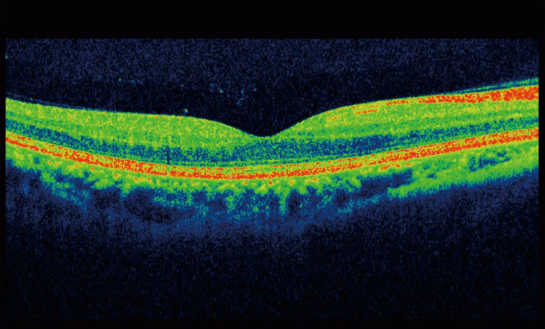 Color-coded optical coherence tomography scan showing detailed layers of the retina with a central depression representing the fovea.