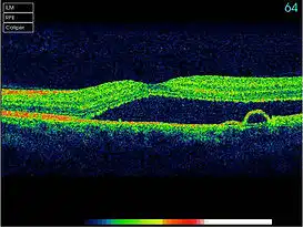 Optical coherence tomography (OCT) scan showing detailed cross-sectional layers of the retina with a distinct elevation and fluid accumulation.