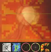 Medical image showing a magnified view of an eye's retina with diagnostic visuals below including angiography and vessel maps.
