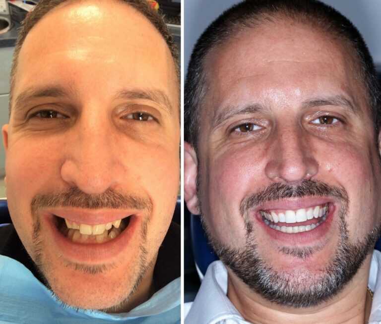 Before and after photos of a Love Teeth patient's smile