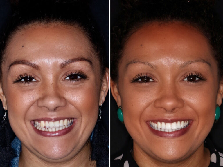 Before and after photos of a Love Teeth patient's smile