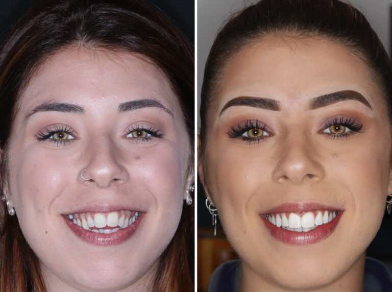 Before and after photos of a Love Teeth patient's smile