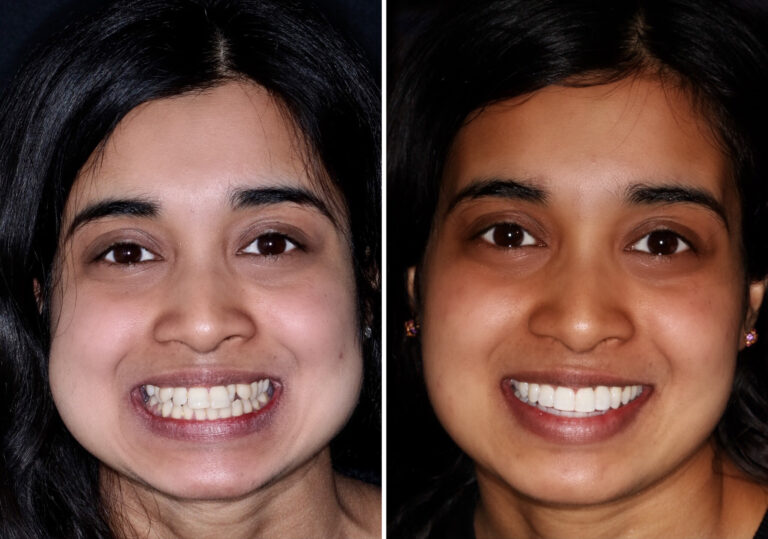Before and after photos of a Love Teeth patient's smile
