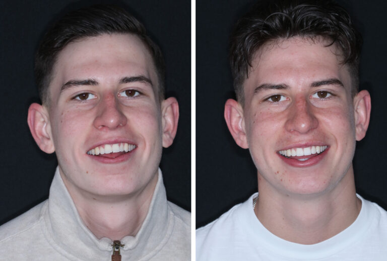 Before and after photos of a Love Teeth patient's smile