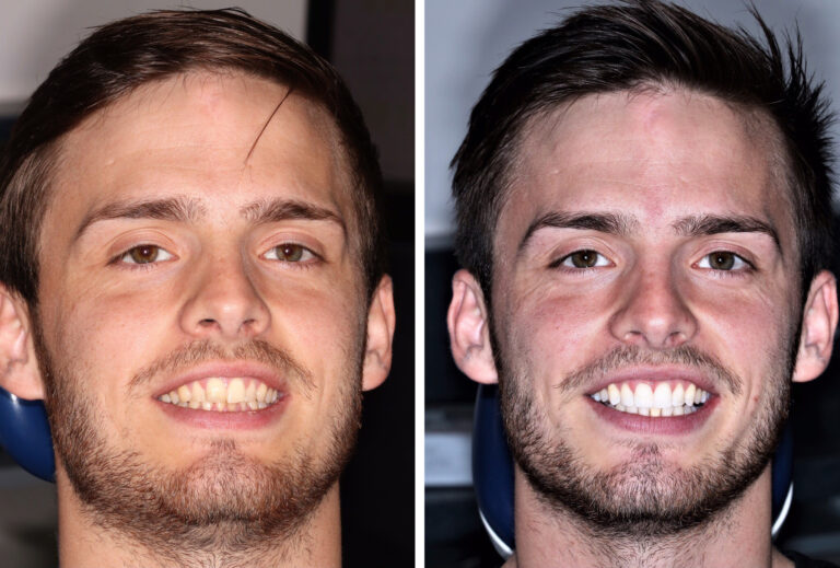 Before and after photos of a Love Teeth patient's smile