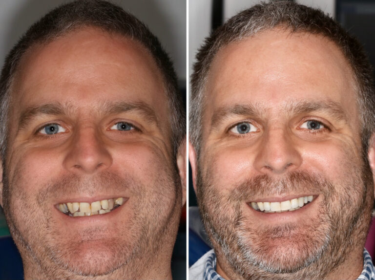 Before and after photos of a Love Teeth patient's smile