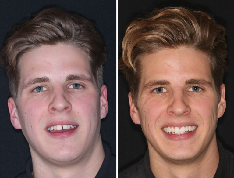 Before and after photos of a Love Teeth patient's smile