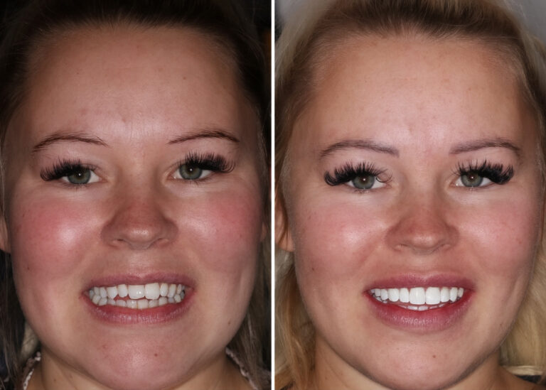 Before and after photos of a Love Teeth patient's smile