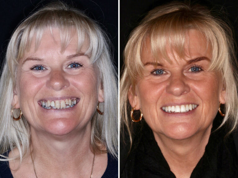 Before and after photos of a Love Teeth patient's smile
