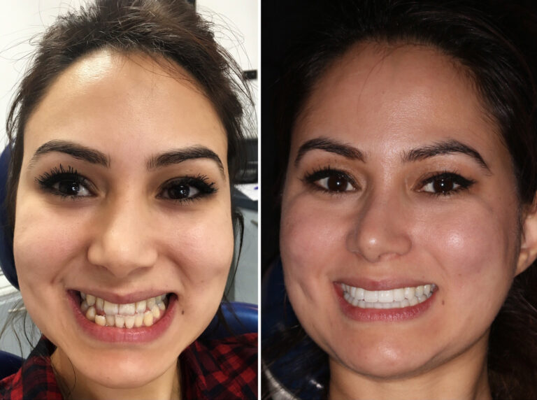 Before and after photos of a Love Teeth patient's smile