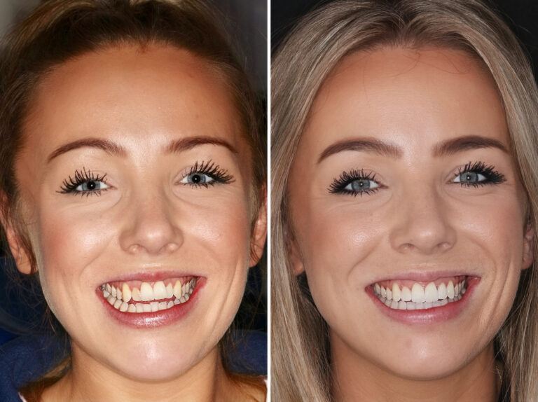 Before and after photos of a Love Teeth patient's smile