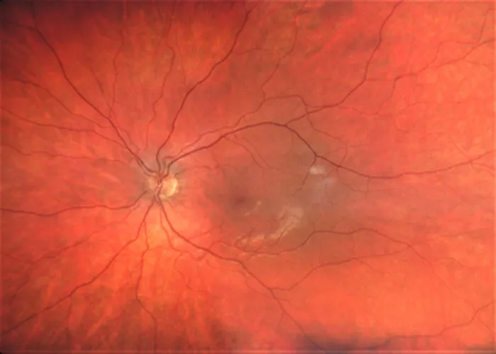 Close-up medical image of the inner retina showing the optic disc and branching retinal blood vessels.