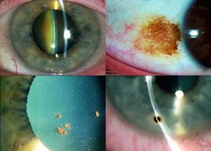 Close-up images of human eyes showing various eye conditions including spots on the sclera and iris.
