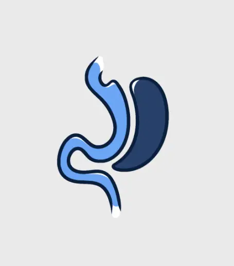 Educational medical illustration of a Gastric Sleeve surgery showing the new stomach pouch, a safe weight loss procedure offered by Dr. Sandy in Tijuana.