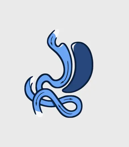 Professional medical illustration of a bariatric surgery procedure showing a stomach modification for weight loss, performed by Dr. Sandy Martinez.