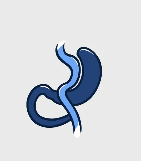 Simplified illustration of a Gastric Sleeve surgery showing the new stomach shape, a premier weight loss procedure at Dr. Sandy’s clinic in Mexico.