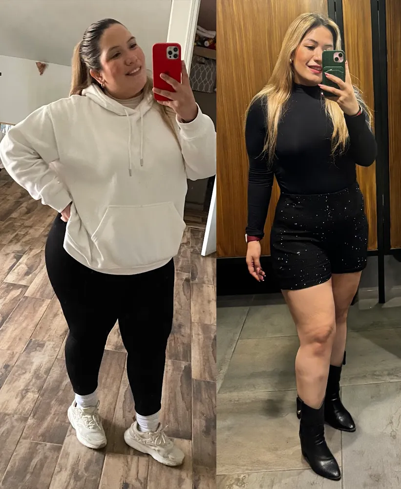 "Before and after weight loss surgery transformation of a female patient. Amazing bariatric success story by SRC Master Surgeon Dr. Sandy Martinez in Tijuana.