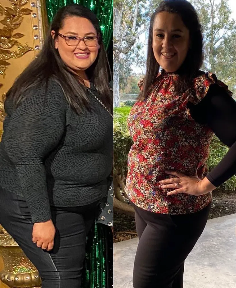 Extreme weight loss transformation before and after. Impactful life-changing results of a patient who lost 200 lbs with Dr. Sandy Bariatrics in Tijuana.
