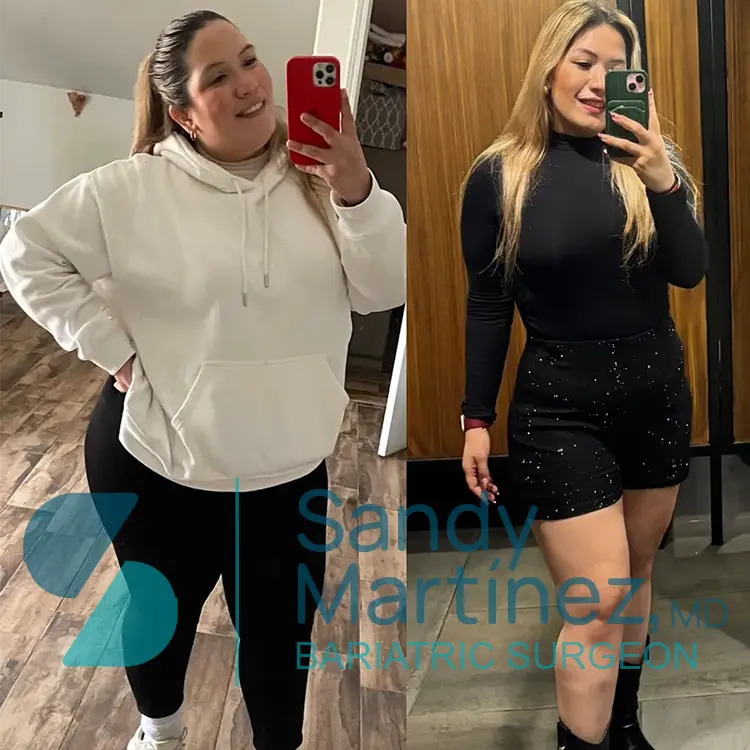 Before and after bariatric surgery weight loss transformation mirror selfies of a female patient at Dr. Sandy Bariatrics.