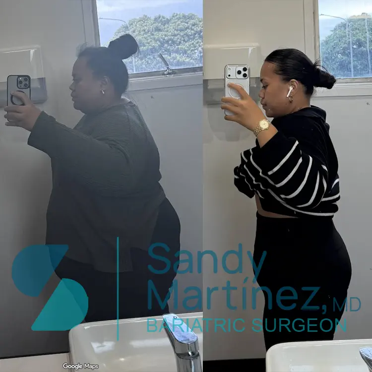 Side-by-side comparison of a woman before and after weight loss, taking bathroom mirror selfies showing a slimmer profile in the after photo.
