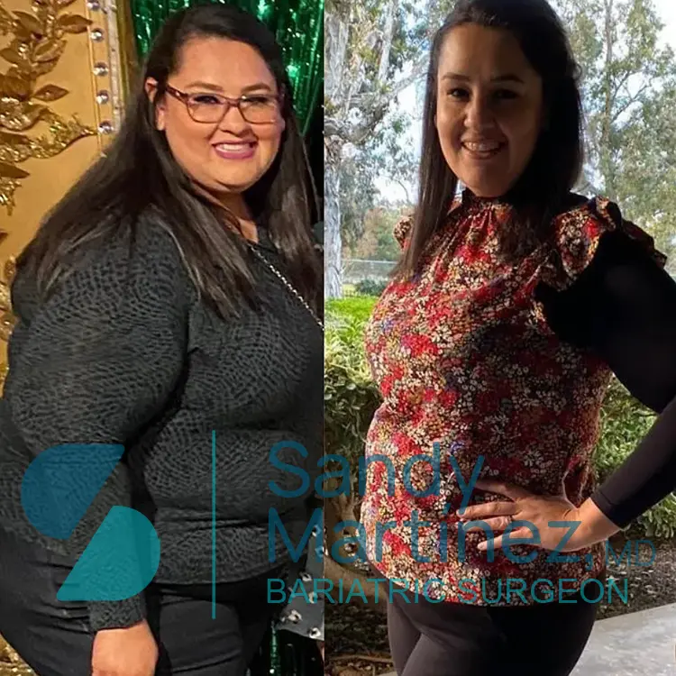 Side-by-side comparison photo of a woman before and after significant weight loss, smiling in both images.