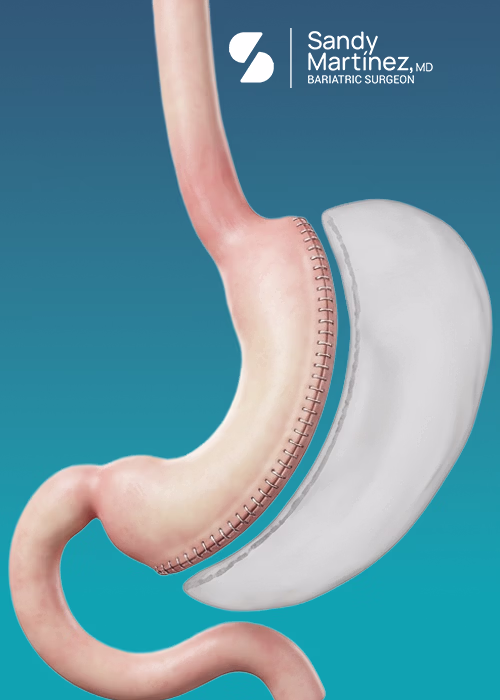 An informative medical illustration of a Gastric Sleeve (VSG). It shows the new narrow, banana-shaped stomach pouch, with a ghosted outline of the 80% removed portion, symbolizing the "metabolic reset" and reduction of Ghrelin for bariatric patients in Tijuana.
